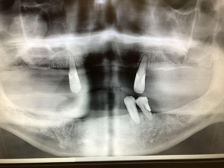 入れ歯からインプラントに変えた際の症例