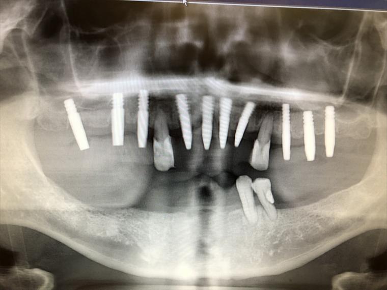 入れ歯からインプラントに変えた際の症例