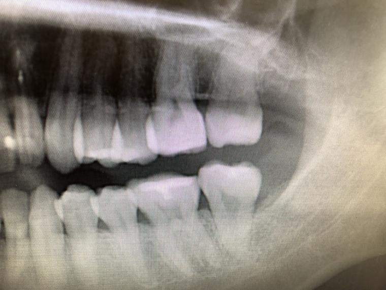 親知らずの抜歯に関する症例
