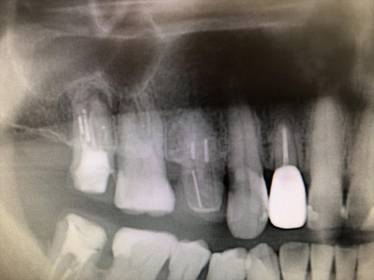 失活歯の経年変化について