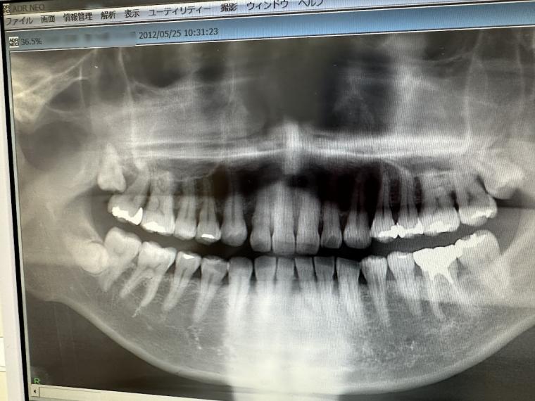 歯を残すための分かれ道