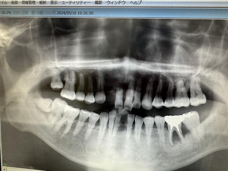 歯を残すための分かれ道