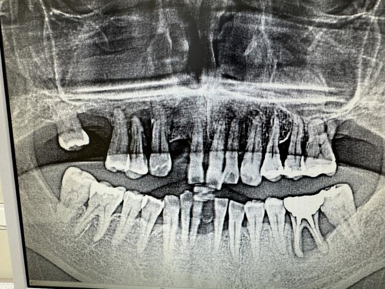 歯を残すための分かれ道