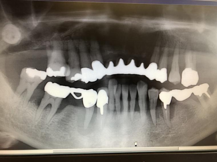 仮のインプラントが活躍した歯周病の症例