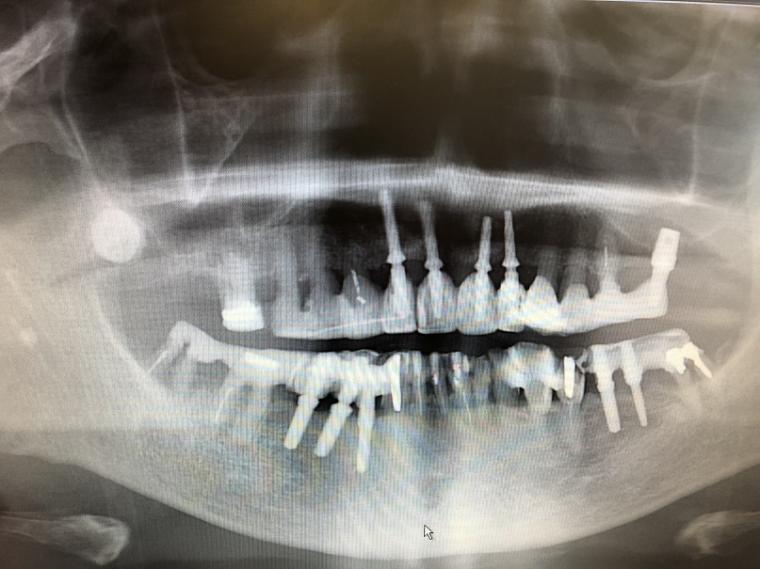 仮のインプラントが活躍した歯周病の症例