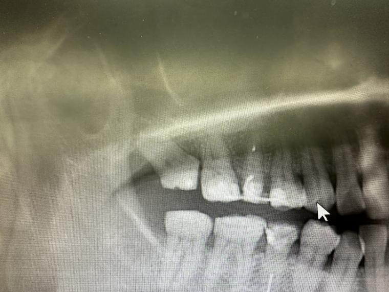 親知らずが活躍した症例のご紹介