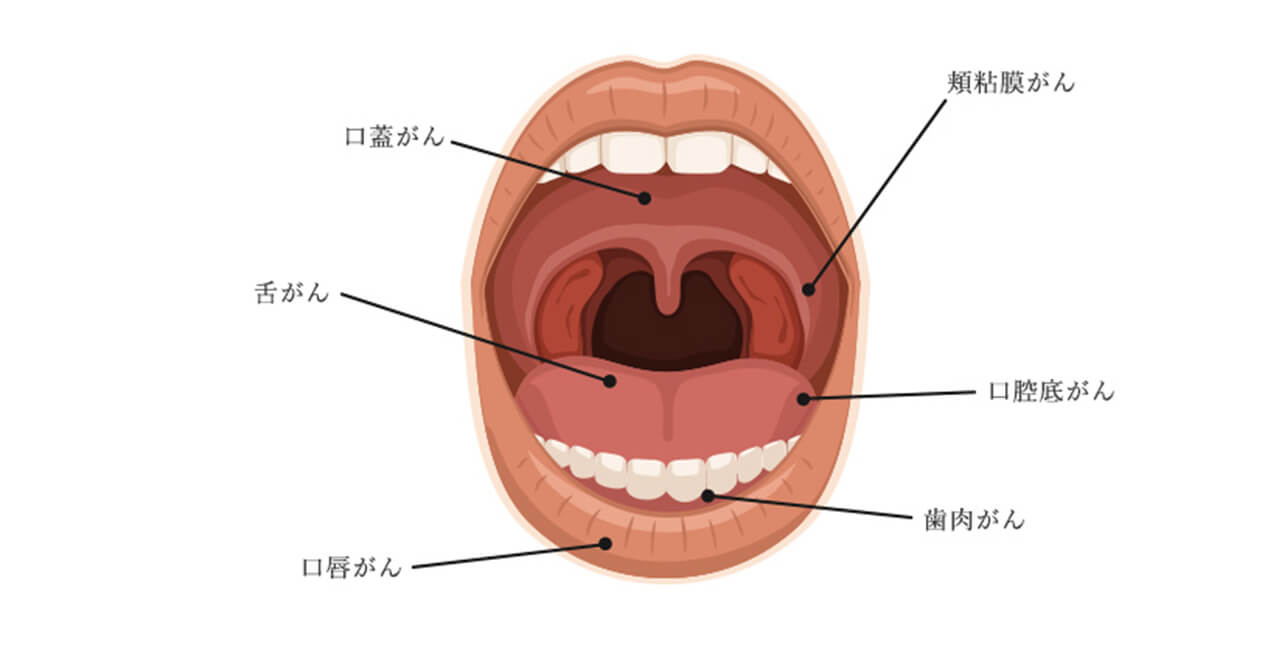 口腔がん・舌癌の症状