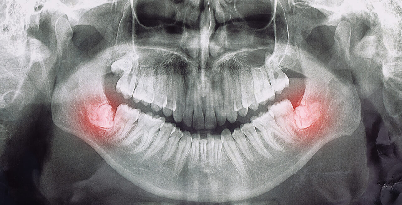 親知らずの抜歯にともなう歯周組織再生療法